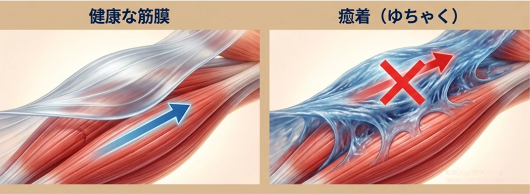 健康な筋膜と、癒着して滑りにくくなった筋膜を左右で比較したイラスト
