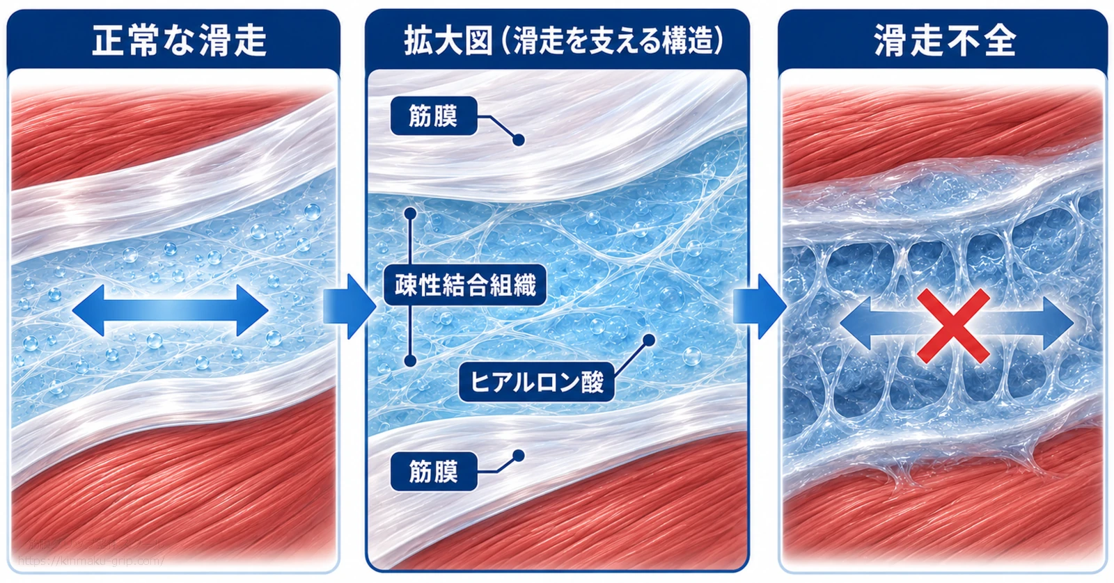 正常な筋膜の滑走と滑走不全を比較し、筋膜間の疎性結合組織とヒアルロン酸が滑走を支える構造を示した3コマ図解
